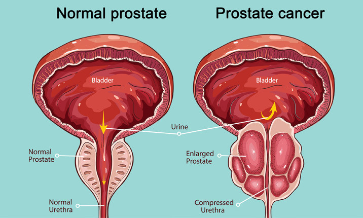 50 Most Effective Tips For healthy Prostate In Man Over 40 #prostate #prostatecancer
