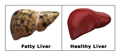 What is Fatty Liver ? How To Overcome From Fatty Liver Problem ? #fattyliver #liverproblem